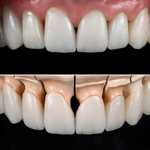 Dental Lenses